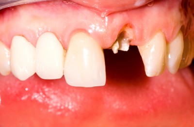 前歯の差し歯が取れた時、緊急に行う対処法と取れない治療法