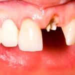 前歯の差し歯が取れた時、緊急に行う対処法と取れない治療法