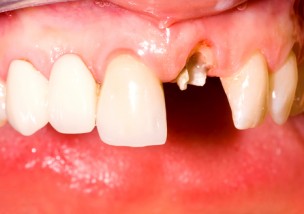 前歯の差し歯が取れた時 緊急に行う対処法と取れない治療法