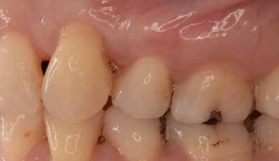 犬歯の八重歯 尖っている 抜歯など７つのトラブルと治療法