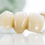 歯のブリッジとは／治療法、費用、寿命、お手入れ法について