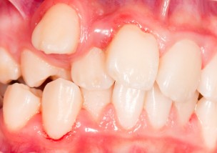 犬歯の八重歯 尖っている 抜歯など７つのトラブルと治療法