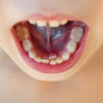 子供の乳歯が抜けない、生え変わらない５つの理由と対応策