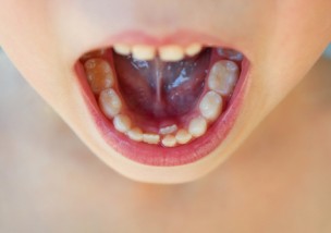 子供の乳歯が抜けない 生え変わらない５つの理由と対応策