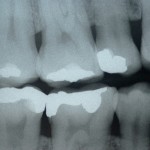 根尖性歯周炎／噛むと痛い、歯茎の腫れなど５つの症状と治療法