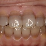 歯がグレーの変色！テトラサイクリン歯を白くする治療法と費用