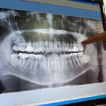歯周病の最新治療！溶けた骨を治す歯周組織再生療法
