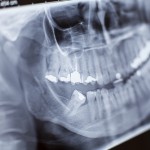 歯根嚢胞の手術の流れと痛み、腫れ、処置後の注意について