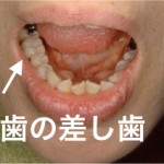 奥歯も白く！奥歯の白い差し歯の自費と保険の種類と特徴