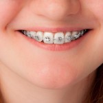 歯医者も知らない！保険診療で歯列矯正ができる５つの条件