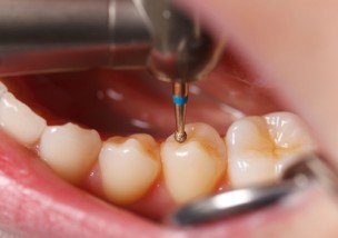 虫歯を発見 歯に見つけた黒い点の３つの原因と治療法