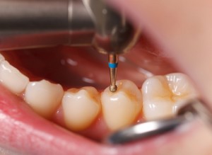 虫歯を発見 歯に見つけた黒い点の３つの原因と治療法