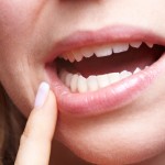 治らない口角炎の原因はカビ！カンジダ性口角炎の原因と薬