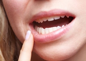 治らない口角炎の原因はカビ カンジダ性口角炎の原因と薬