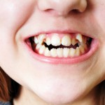 MFTとは／歯列矯正で舌や口の周りの筋トレを行う４つの理由