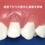 歯列矯正後の歯茎下がりや歯茎の隙間を治す／歯周病専門医