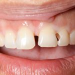 歯の詰め物が虫歯などで取れたり、欠けたら新百合ヶ丘駅徒歩１分のアコルデ歯科医院