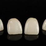 薄いセラミックのラミネートベニアで歯の変色や隙間を綺麗にする方法と費用