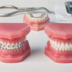 大人の矯正歯科の選び方4つのポイントと矯正歯科で聞いておくべきこと
