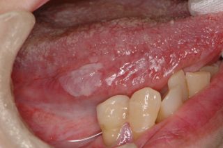 舌癌 舌がん を疑ってほしい６つの異常と口内炎との比較 治療法