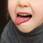 舌癌（舌がん）を疑ってほしい６つの異常と口内炎との比較／治療法