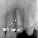 歯を抜く前に！歯を残すための最新根管治療／おかざき歯科クリニック横浜・戸塚