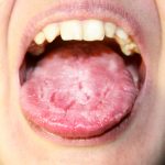 溝状舌（こうじょうぜつ）とは／溝状舌の痛みの原因と対処法