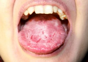 溝状舌 こうじょうぜつ とは 溝状舌の痛みの原因と対処法