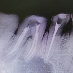 根管治療の失敗やトラブル７例／安心して任せられる歯医者の選び方