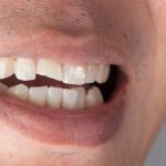歯ぎしり対策／すぐにすべき対策と日常生活における対策