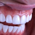 もう悩まない！出っ歯を短期間キレイに治す３つの治療法と子供の治療