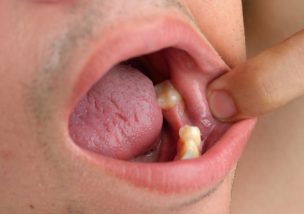 1週間 2週間 1か月 治らない口内炎に対処すべき方法