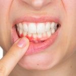 歯がしみる！知らずに悪化させている知覚過敏の６つの原因と対処法