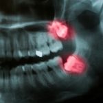 横向きの親知らずを腫れや痛みを最小限に抑える抜歯法と手順