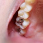 奥歯の歯茎が腫れる６つの原因と治療法